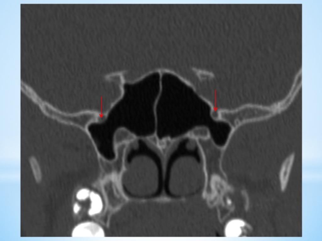 Fig. 20: Coronal NECT shows is hyperpneumatization of the sphenoidal sinuses with the foramen