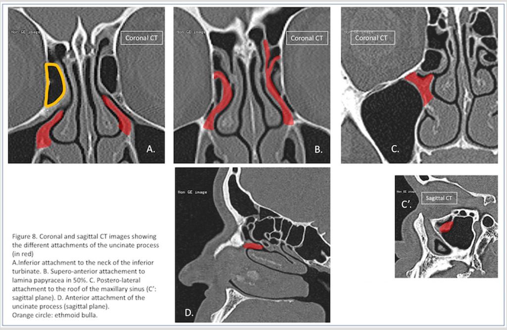 Fig. 8: Figure 8. Coronal and sagittal CT images showing the different attachments of the uncinate process (in red) A.Inferior attachment to the neck of the inferior turbinate. B.