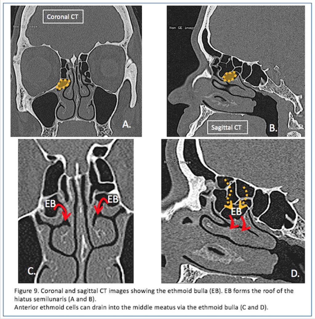 Fig. 9: Figure 9. Coronal and sagittal CT images showing the ethmoid bulla (EB).
