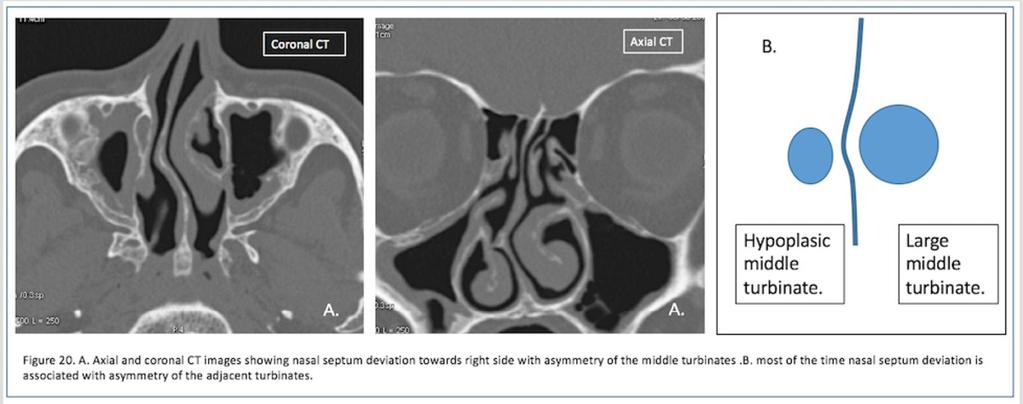 Fig. 19: Figure 19. Coronal image and axial cut in the level of the anterior ethmoidal artery.