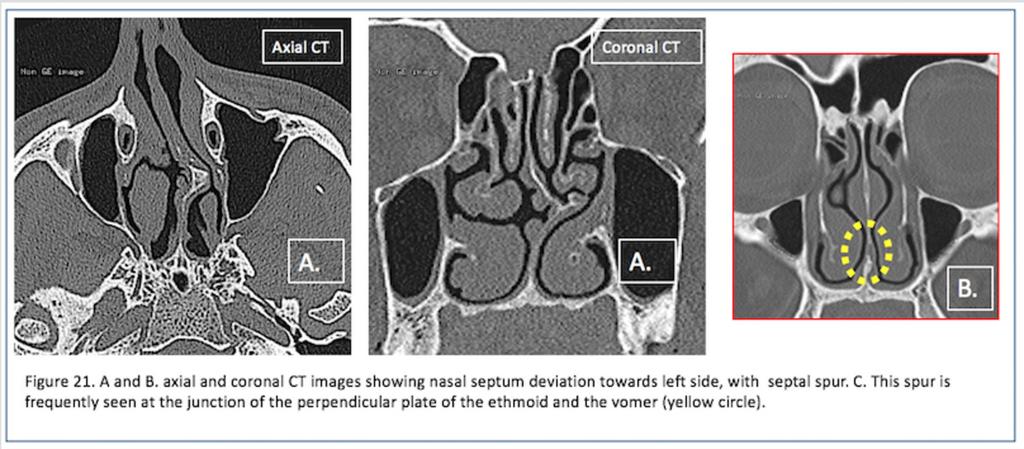 Fig. 20: Figure 20. A. Axial and coronal CT images showing nasal septum deviation towards right side with asymmetry of the middle turbi