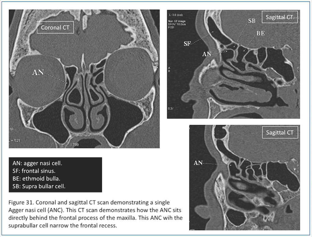 Fig. 31: Figure 31. Coronal and sagittal CT scan demonstrating a single Agger nasi cell (ANC).