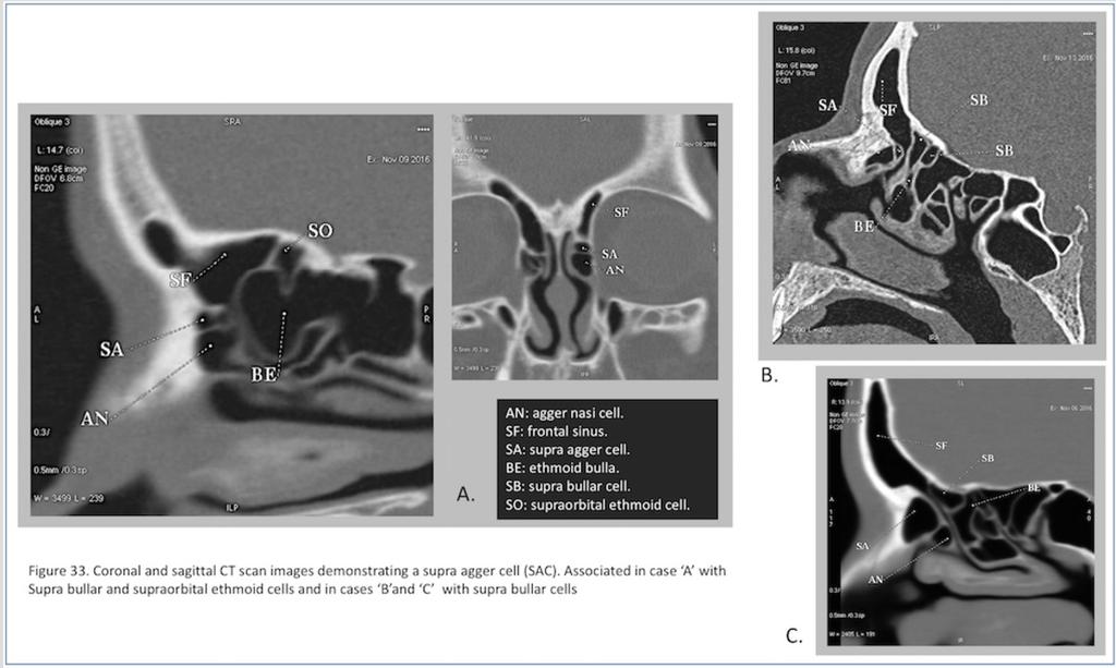 Fig. 33: Figure 33. Coronal and sagittal CT scan images demonstrating a supra agger cell (SAC).