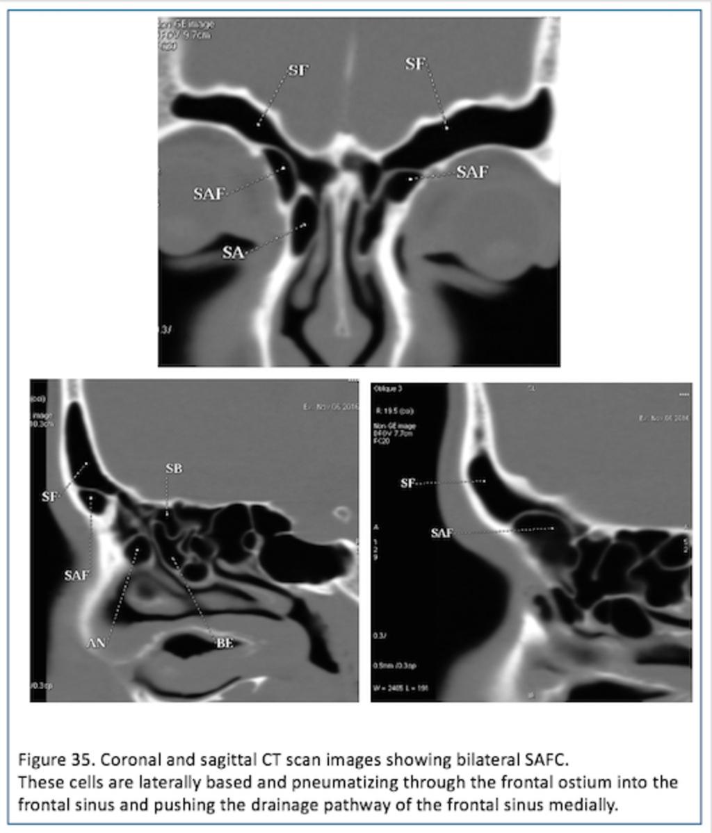 Fig. 35: Figure 35. Coronal and sagittal CT scan images showing bilateral SAFC.
