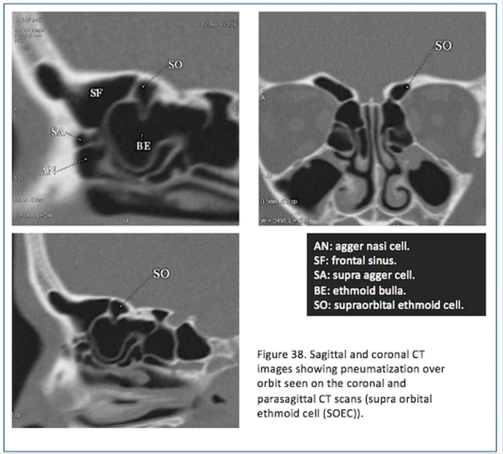 Fig. 37: Figure 37. Coronal and sagittal CT scan images illustrating the SBFC pushing the frontal sinus drainage pathway anteriorly until it touches the SAFC.