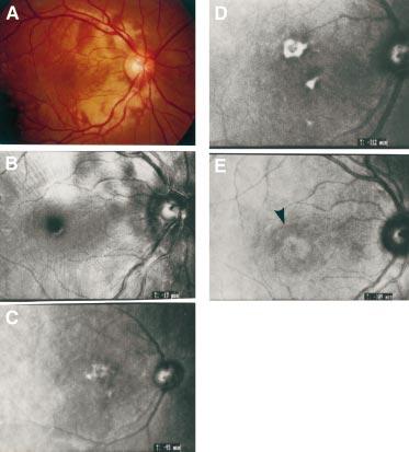 Videofunduscopy and videoangiography in Vogt Koyanagi Harada syndrome 1177 deeper retina, and RPE/choroid, respectively.