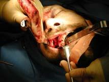 Surgical complications ZYGOMATICOMAXILLARY & ORBITAL FRACTURES Malunion, Nonunion, Plate Exposure Palpable