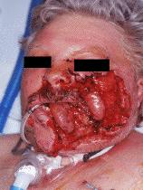 Airway Most urgent complication Airway compromise Simple interventions first No mandible?