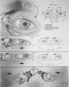 Pseudohypertelorism (Traumatic Telecanthus) Anatomy Medial Canthal