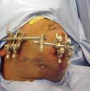 ecchymosis Nerve injury Plain films Panorex CT Open Fractures
