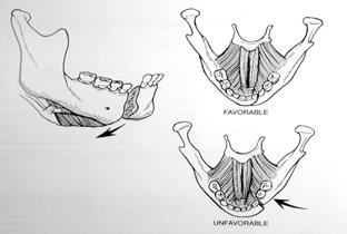 Pterygoid Muscles