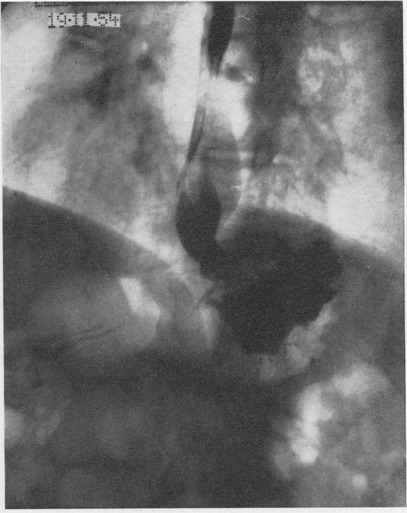 FIG. 8.-Case 2: A chronic gastric ulcer involving the cardia and FIG. 9.