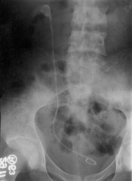 544 Figure 1. X-ray KUB showing ureteric stent in right renal unit with a large stone formation at the upper end. Figure 3. X-ray KUB Kidney, ureter and bladder showing a upmigrated stent.