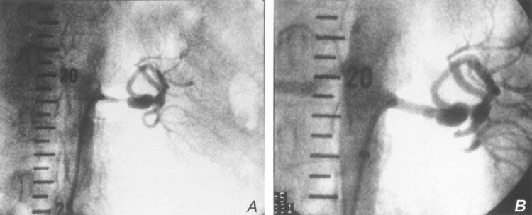 620 Rodriguez-Lopez et al April 1999 Fig 1. Typical ostial lesion in hypertensive patient. A, Preoperative angiogram. B, Angiogram after placement of Palmaz stent P154 (1.