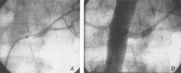 arteries) with bilateral lesions that were treated simultaneously, and two of the patients had accessory renal artery stenosis (Fig 3).