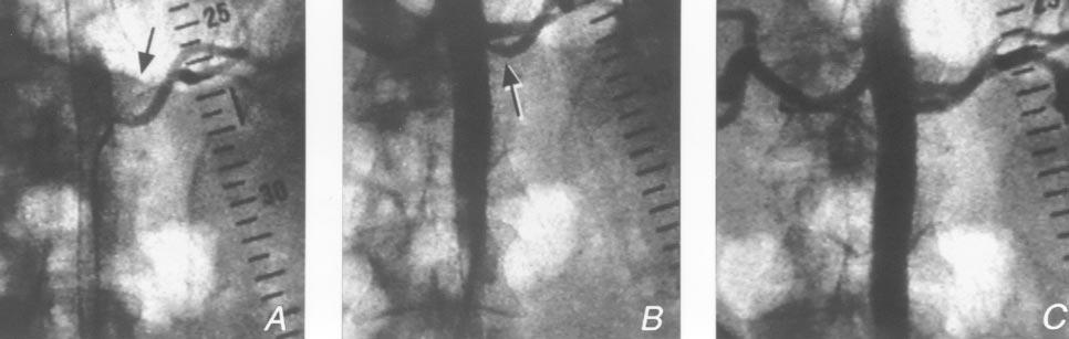 Volume 29, Number 4 Rodriguez-Lopez et al 621 Fig 3. Left renal and accessory renal artery stenosis.