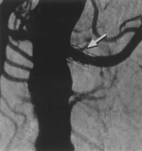 624 Rodriguez-Lopez et al April 1999 Fig 6. Follow-up examination at 22 months of left renal artery stent in patient who is asymptomatic.