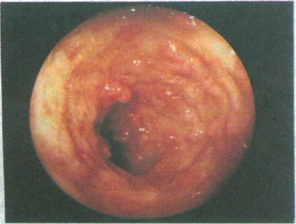Severe manifestations of Crohn's disease with multiple enterocutaneous fistulas. Incidence The incidence of ulcerative colitis has remained static at 26/100 000 population.