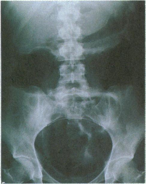 Radiological progression shows U w =- _ S ulceration, pseudopolyps, and, finally, an atrophic "hosepipe" colon.