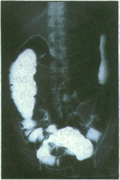 Diagnosis a colonoscope. Radiograph showing segmented Crohn's colitis in transverse colon.