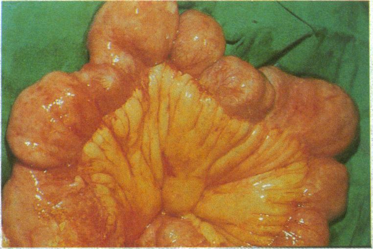 Small bowel with multiple strictures. Obstructive symptoms caused by small bowel and ileocaecal Crohn's disease often respond to steroids and a low residue diet.