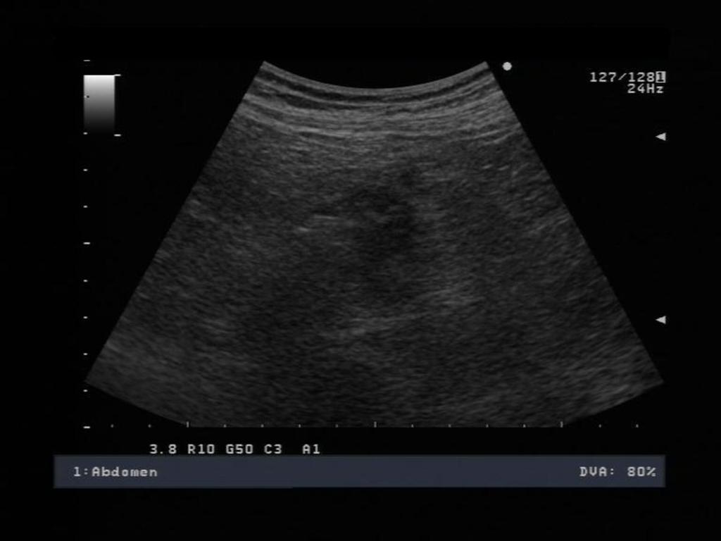 Fig. 8: Ileocecal valve showing an irregular, thickened, edematous and