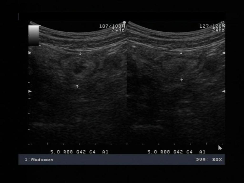 Fig. 9: Ileocecal edematous valve with normal contour in