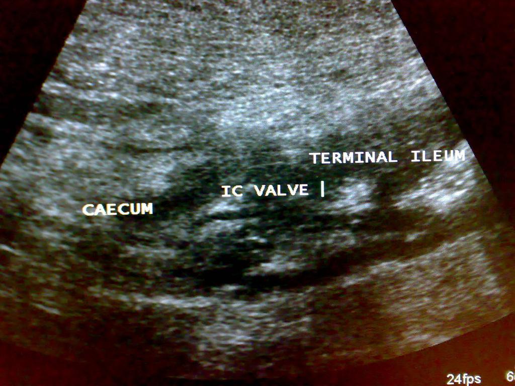 Fig. 13: Thickening of the ileocecal valve in