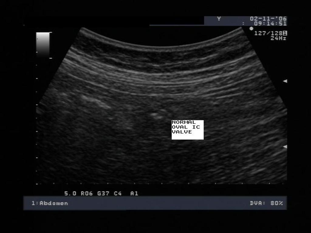 Fig. 2: Normal Oval appearance of the ileocecal