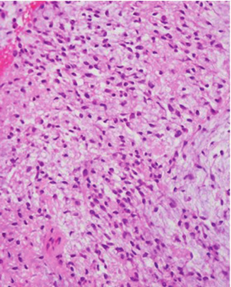 CM is chrcterized by hypercellulr res tht occupy from 10 to 90% of the tumor.