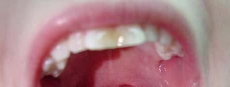 Tonsils and adenoids Chronic tonsillitis Tonsillar hyperplasia