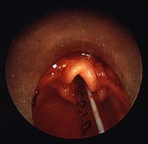 Laryngeal Cyst