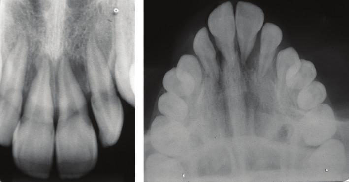 However, the single location of the condition, its absence in posterior quadrants of the maxilla and/or mandible, its exudative appearance, and the radiographic