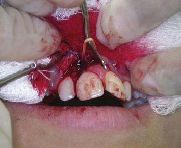 To our surprise, an elastic band involving the midportion of the roots of the two central incisors was found during biopsy (Figure 3).