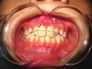 dentist had treated a friend with diastema in the same region using an elastic band.