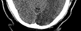 dense MCA sign CT also helpful to look for