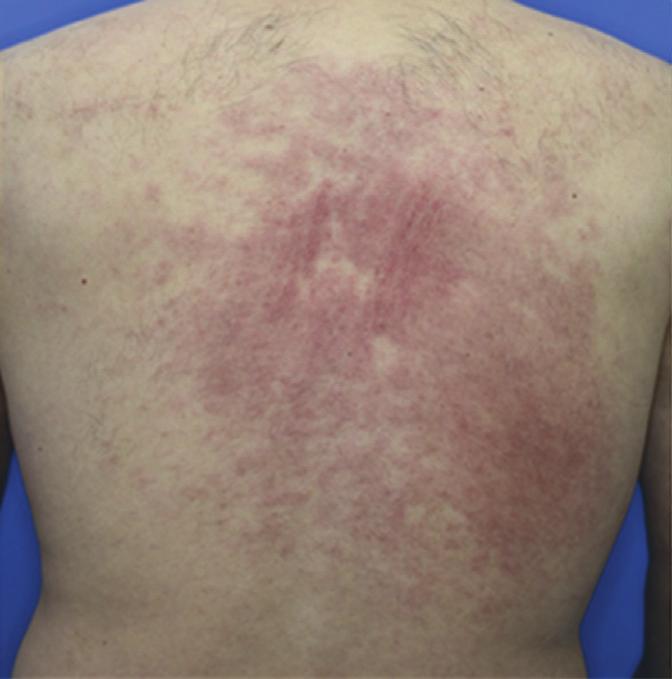 back (b) before the initiation of treatment.