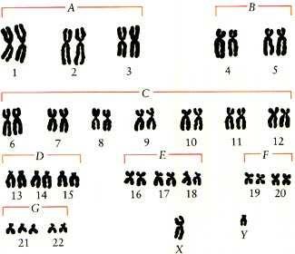 16. Study the karyotype shown to the right. a) What is the sex of this person? Male b) What is the name of the syndrome of this person?