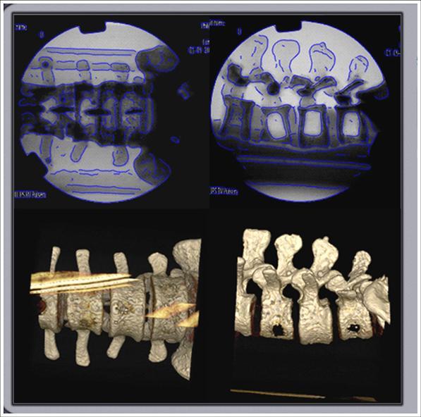 Spine surgery: 3D FluoroMerge Accuracy of pedicles screw positioning