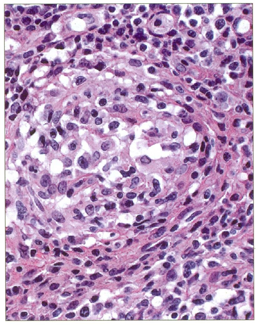 Angiocentric T-Cell-Lymphoma