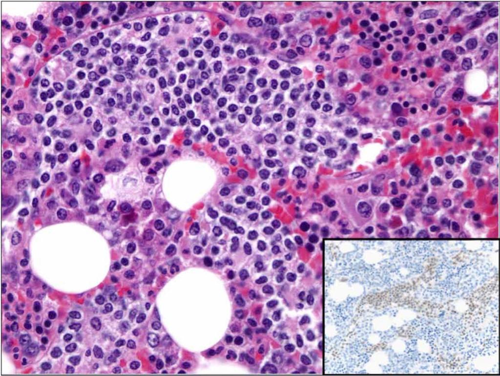 A Bone marrow biopsy shows prominent distinctly intrasinusoidal infiltrate of medium-sized T