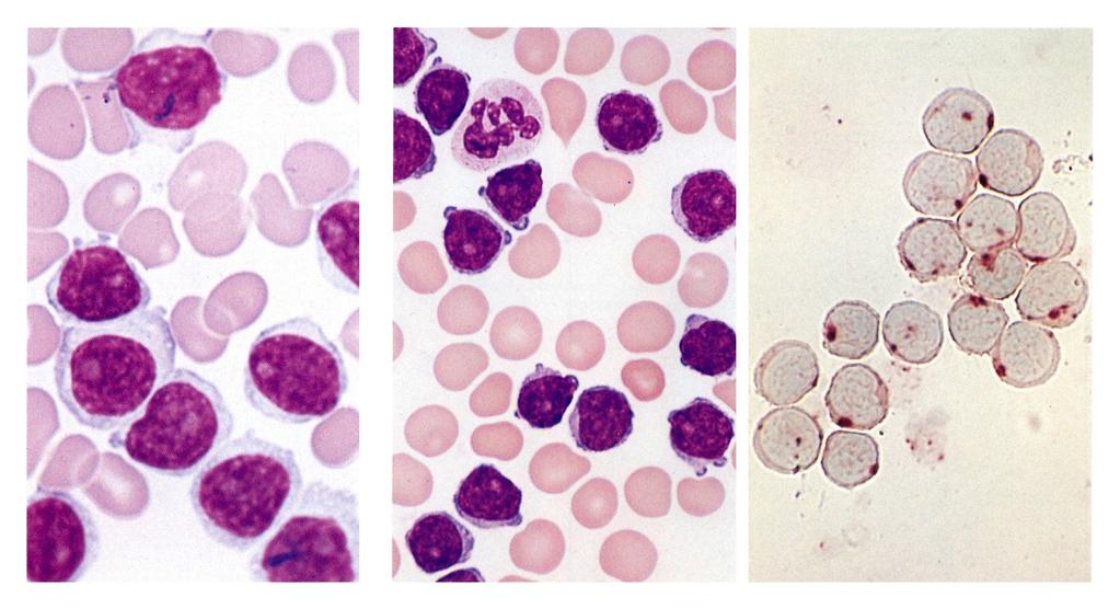 T- and B-cell prolymphocytic Leukemia B-cell prolymphocytic leukemia surface Immunglobulin T-cell