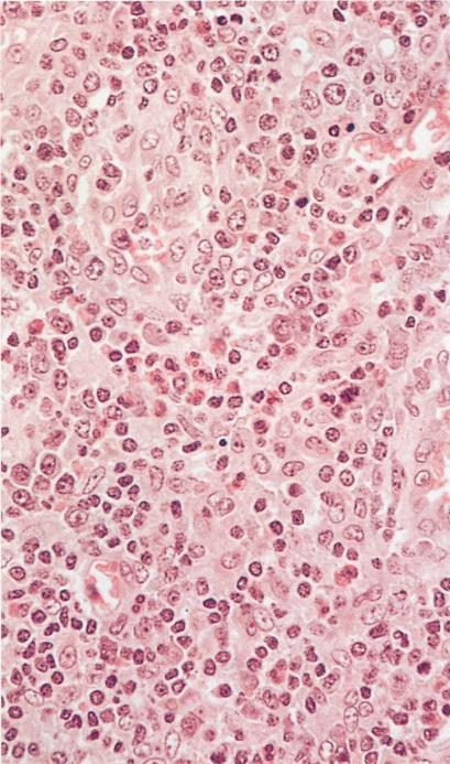 Angioimmunoblastic T-Cell-Lymphoma Angioimmunoblastic Lymphadenopathy: