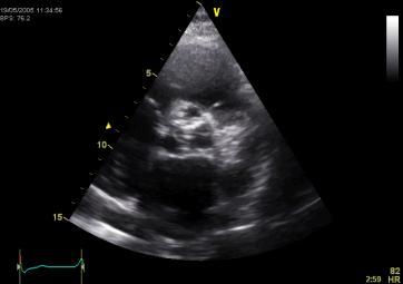 AORTIC STENOSIS First valvular