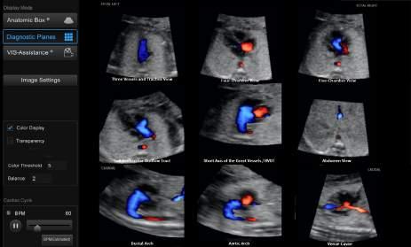 confident decisions. 5D NT (Nuchal translucency measurement) With Samsung's 5D NT, operator dependency can be reduced for the first trimester fetal nuchal translucency (NT) measurement.
