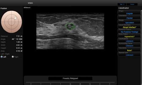 S-Detect (S-Detect for breast) By simply clicking a suspicious lesion, S-Detect draws the lesion borders, suggests the characteristics of the lesion and