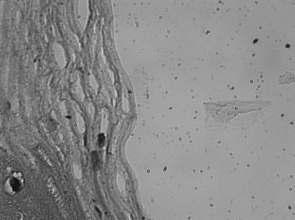 Clinical results Two-photon microscopy image Hematoxylin & Eosin - SETTINGS: Fluence 20 J/cm2 Pulse duration 300 µs