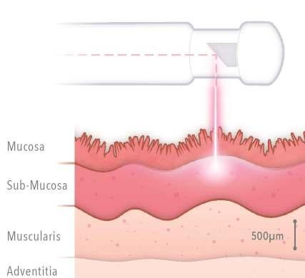 Indications Vaginal Atrophy & Tightening The wall of the vagina is composed of the following layers: Epithelium: Internal lining of epithelial tissue made up of squamous epithelial cells Lamina