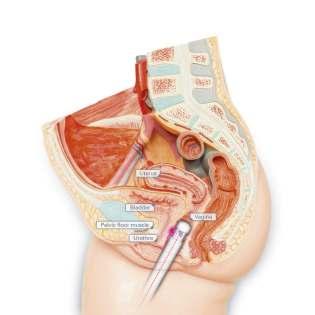 Indications Vaginal Atrophy & Tightening Juliet is a minimally invasive treatment, the goal of which is to restore the original metabolism of connective tissue and improve the state of the mucosa, by