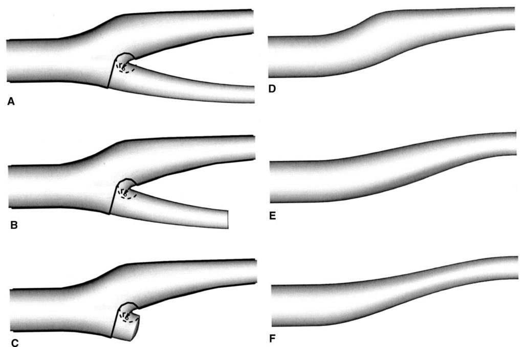 JOURNAL OF VASCULAR SURGERY Volume 37, Number 6 Hyun et al 1249 Fig 1. Occlusion geometry for six carotid bifurcations studied. A, Normal carotid artery bifurcation geometry. B, Distal ECA occlusion.